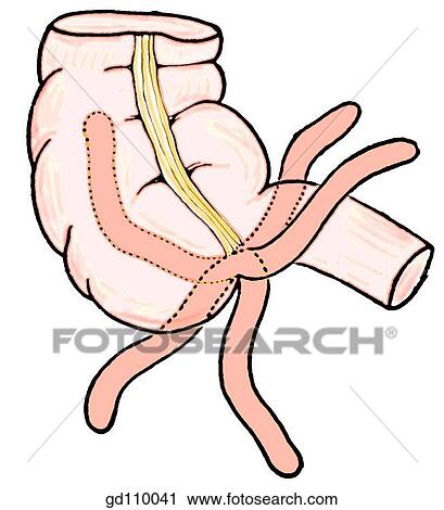 Clip Art - Various position of vermiform appendix (most commonly retrocecal).. Fotosearch