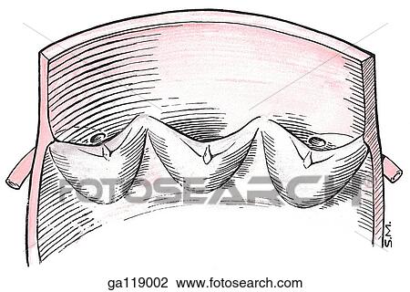 View of an aortic valve that has been spread out showing the right, posterior, and left valves. View Large Illustration Drawing - View of an aortic valve that has been spread out showing the right, posterior, and left valves.. Fotosearch