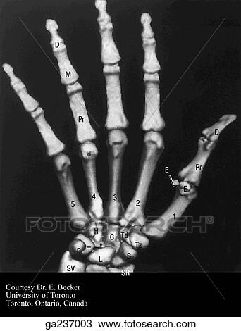 3D computer-generated image of wrist and hand: D, distal phalanx; Pr, proximal phalanx; F, sesamoid; Td, trapezoid; Tz, trapezium; c, capitate; s, scaphoid; L, lunate; SR, styloid process of radius; Su, styloid process of ulna; P, pisiform; H, hook of ham View Large Illustration Drawing - 3D computer-generated image of wrist and hand: D, distal phalanx; Pr, proximal phalanx; F, sesamoid; Td, trapezoid; Tz, trapezium; c, capitate; s, scaphoid; L, lunate; SR, styloid process of radius; Su, styloid process of ulna; P, pisiform; H, hook of ham. Fotosearch