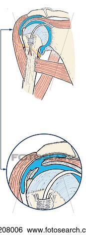 A, Subacromial bursa and its relationship to the acromion, deltoid muscle and the tendon of the supraspinatus muscle. Coronal section; anterior view. B, Attrition of supraspinatus tendon and underlying joint capsule leads to communication between should j View Large Illustration Stock Illustration - A, Subacromial bursa and its relationship to the acromion, deltoid muscle and the tendon of the supraspinatus muscle. Coronal section; anterior view. B, Attrition of supraspinatus tendon and underlying joint capsule leads to communication between should j. Fotosearch