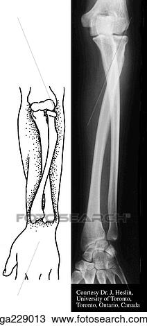 Anterior radiograph of forearm in pronation showing the radioulnar joints. View Large Illustration Drawing - Anterior radiograph of forearm in pronation showing the radioulnar joints.. Fotosearch