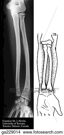 Anterior radiograph of forearm in supination showing the radioulnar joints. View Large Illustration Stock Illustration - Anterior radiograph of forearm in supination showing the radioulnar joints.. Fotosearch