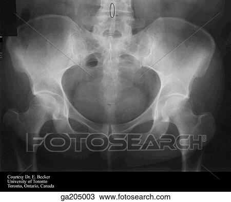 Anterior radiograph of the pelvis, with part of the lumbar spine and femur. View Large Illustration Drawing - Anterior radiograph of the pelvis, with part of the lumbar spine and femur.. Fotosearch
