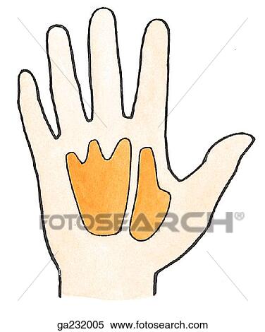 Anterior view of the extent of the compartments of the hand, showing the midpalmar and thenar spaces. View Large Illustration Stock Illustration - Anterior view of the extent of the compartments of the hand, showing the midpalmar and thenar spaces.. Fotosearch