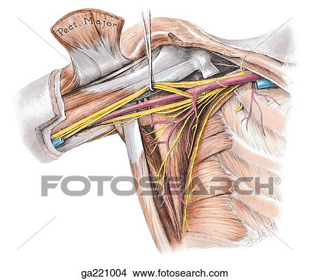 Stock Illustration - Anterior view of the posterior and medial walls of the axilla with pectoralis minor muscle excised, lateral and medial cords retracted, and axillary vein removed.. Fotosearch