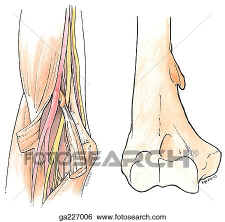 Anterior view of the supracondylar process of the humerus, showing the biceps, ulnar n., superior ulnar collateral a., brachial a., median n., and pronator teres. In the right image the anatomy has been removed to isolate the supracondylar process. View Large Illustration Stock Illustration - Anterior view of the supracondylar process of the humerus, showing the biceps, ulnar n., superior ulnar collateral a., brachial a., median n., and pronator teres. In the right image the anatomy has been removed to isolate the supracondylar process.. Fotosearch