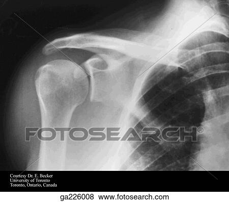 Stock Illustration - Anterolateral radiograph of the shoulder.. Fotosearch