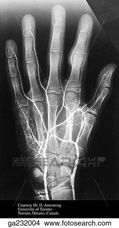 Anteroposterior arteriogram of the hand. View Large Illustration Stock Illustration - Anteroposterior arteriogram of the hand.. Fotosearch