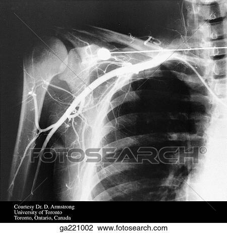 Anteroposterior axillary arteriogram. View Large Illustration Drawing - Anteroposterior axillary arteriogram.. Fotosearch