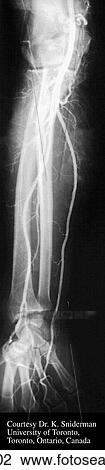 Anteroposterior brachial arteriogram. View Large Illustration Drawing - Anteroposterior brachial arteriogram.. Fotosearch