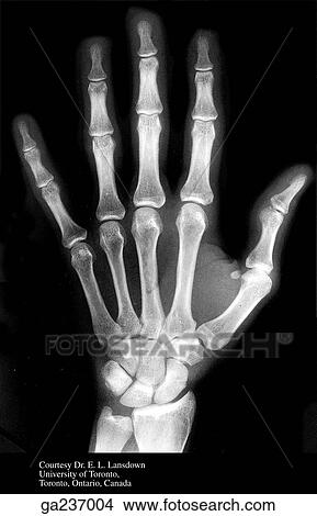 Stock Illustration - Anteroposterior radiograph of the bones of the hand and wrist.. Fotosearch