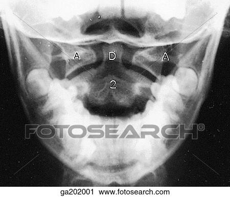 Clip Art - Anteroposterior radiograph of the atlantoaxial joint, showing the body of the axis (2), the dens (D), and the atlas (A); image is taken through the open mouth.. Fotosearch