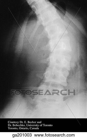 Drawing - Anteroposterior radiograph of the lumbar spine during lateral bending.. Fotosearch