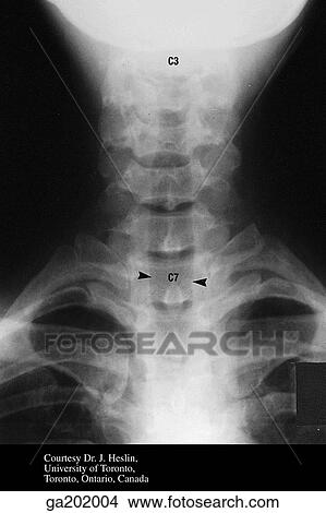 Anteroposterior radiograph of the cervical spine, showing the margins of air in the trachea (black arrows) and the overlapping articular and transverse processes (boxed area). View Large Illustration Stock Illustration - Anteroposterior radiograph of the cervical spine, showing the margins of air in the trachea (black arrows) and the overlapping articular and transverse processes (boxed area).. Fotosearch