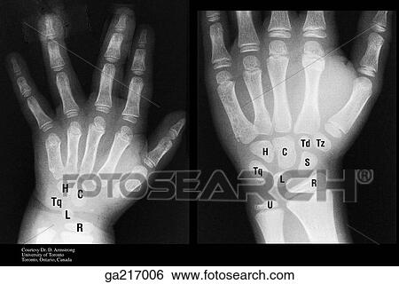 Stock Illustration - Anteroposterior radiographs of stages of ossification of wrist and hand (H, hamate; C, capitate; Tq, triquetrum; L, lunate; R, radius; Td, trapezoid; Tz, trapezium; S, scaphoid; U, ulna).. Fotosearch