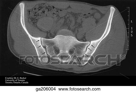 Axial CT of sacroiliac joint, which is indicated by arrows. Stock