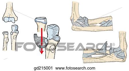 Clip Art - Bony landmarks of the elbow joint. The head of the radius is inserted into the anular ligament that holds the radius to the ulna. the joint capsule of the elbow joint is reinforced by ligaments.. Fotosearch
