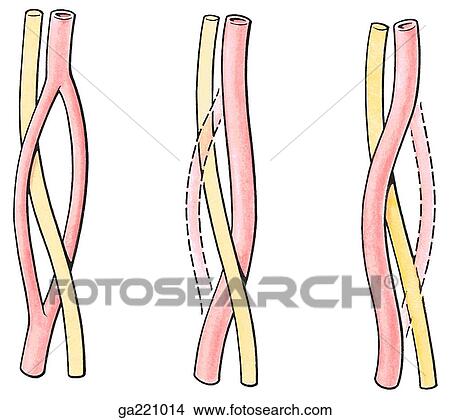 Brachial artery (red) and median nerve (yellow) anomalies. In 307 limbs studied, both primitive brachial arteries persisted in 5% (left image), the posterior in 82% (middle image), and the anterior in 13% (right image). View Large Illustration Stock Illustration - Brachial artery (red) and median nerve (yellow) anomalies. In 307 limbs studied, both primitive brachial arteries persisted in 5% (left image), the posterior in 82% (middle image), and the anterior in 13% (right image).. Fotosearch