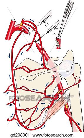 Colateral, circulação, para, braço, após, ligation, de, a, axilar