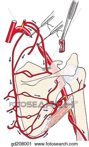 Collateral circulation to arm after ligation of the axillary artery. Arrows indicate direction of adjusted blood flow. View Large Illustration Clip Art - Collateral circulation to arm after ligation of the axillary artery. Arrows indicate direction of adjusted blood flow.. Fotosearch