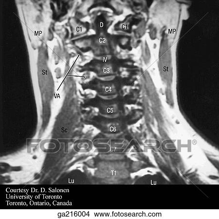 Stock Illustration - Coronal MRI of the cervical spine, posterior view (D, dens; IV, intervertebral disc; MP, mastoid process; St, sternomastoid; Lu, lungs).. Fotosearch