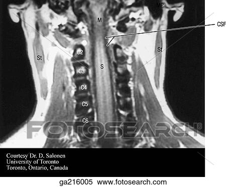 Stock Illustration - Coronal MRI of the cervical spine, posterior view (M, medulla oblongata; St, sternomastoid; S, spinal cord).. Fotosearch