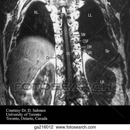 Drawing - Coronal MRI of thoracic spine and spinal cord (RL, right lung; LL, left lung; SN, spinal nerve; CSF, cerebrospinal fluid; DR, dorsal primary ramus; VR, ventral primary ramus; SC, spinal cord; Sp, spleen; LK, left kidney; Cr, crus of diaphragm; RK, right k. Fotosearch