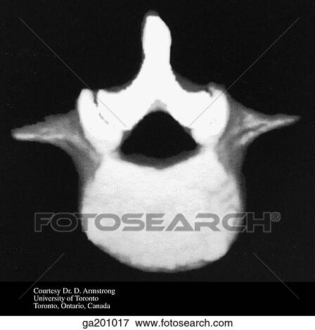 Inferior 3D computer-generated view of vertebra in 18-year-old; secondary centers of ossification are fused. View Large Illustration Stock Illustration - Inferior 3D computer-generated view of vertebra in 18-year-old; secondary centers of ossification are fused.. Fotosearch