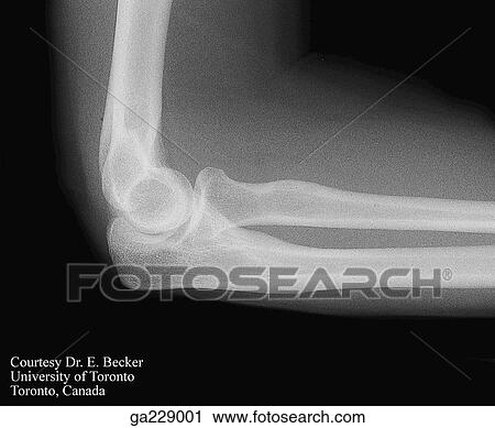 Lateral radiograph of elbow joint, showing triceps brachii, supracondylar ridge, trochlea, olecranon, trochlear notch, ulna, and head, neck, and tuberosity of radius. View Large Illustration Clip Art - Lateral radiograph of elbow joint, showing triceps brachii, supracondylar ridge, trochlea, olecranon, trochlear notch, ulna, and head, neck, and tuberosity of radius.. Fotosearch
