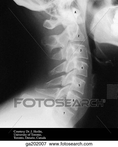 Stock Illustration - Lateral radiograph of the cervical vertebrae, showing the atlas.. Fotosearch