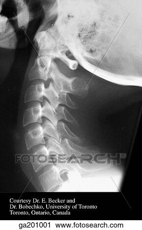 Clip Art - Lateral radiograph of the extended cervical spine.. Fotosearch