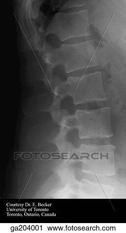 Lateral radiograph of the lumbar vertebrae. View Large Illustration Clip Art - Lateral radiograph of the lumbar vertebrae.. Fotosearch