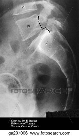 Stock Illustration - Lateral radiograph showing spondylolysis; the dotted line shows the anterior displacement of L5 (spondylolisthesis).. Fotosearch