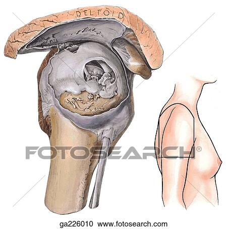 Clipart - Lateral view of attrition of the supraspinatus tendon; subacromial bursa has been cut away. The image to the right indicates the orientation of the main illustration.. Fotosearch