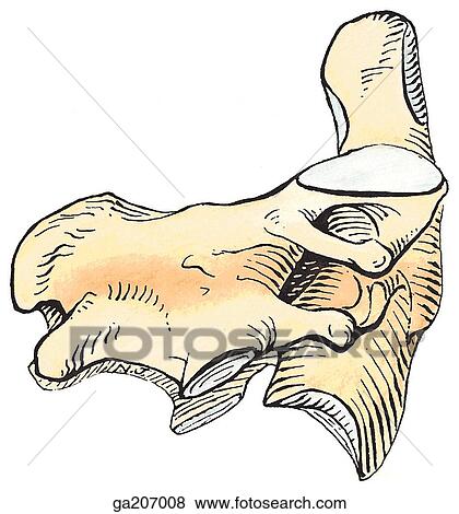 Stock Illustration - Lateral view of synostosis of C2 and C3.. Fotosearch