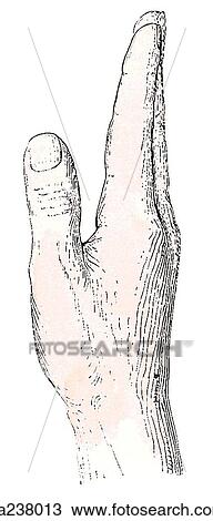 Drawing - Lateral view of the extended hand.. Fotosearch