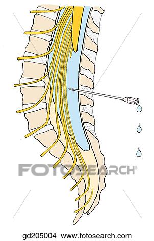 Lumbar puncture. View Large Illustration Stock Illustration - Lumbar puncture.. Fotosearch