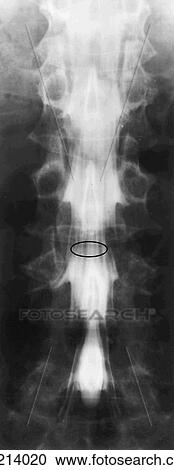 Clipart - Myelogram of the lumbar region of the vertebral column; contrast medium is injected in the subarachnoid space.. Fotosearch