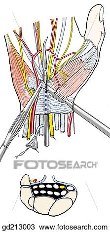 Drawing - Opening of the carpal tunnel. The inserted probe protects the contents.. Fotosearch
