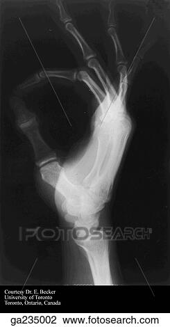Radiograph of lateral aspect of hand. View Large Illustration Drawing - Radiograph of lateral aspect of hand.. Fotosearch