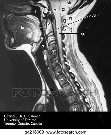 Stock Illustration - Sagittal MRI of cervical and upper thoracic spine, lateral view (Cb, cerebellum; M, medulla oblongata; PT, pos. tubercle; 1, nasopharynx; 2, oropharynx; 3, laryngopharynx; Ton, tongue; D, dens; SP, spinous process; SC, spinal cord; IV, intervertebral disc. Fotosearch