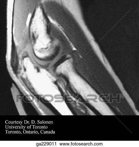 Clip Art - Sagittal MRI of elbow showing triceps brachii, brachioradialis, fibrous capsule, trochlea of humerus, trochlea notch, olecranon, ulna, and head, neck, and tuberosity of radius.. Fotosearch
