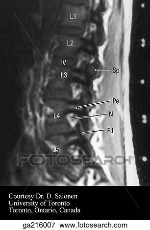 Stock Illustration - Sagittal MRI of lumbar spine (IV, intervertebral disc; Sp, spinous process; Pe, pedicle; N, spinal nerve; FJ, zygapophyseal joint. ). Fotosearch