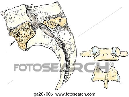 Sagittal section (left) and posterior view (right) showing L5 vertebra with spondylolysis; left image also shows spondylolisthesis (anterior displacement). View Large Illustration Stock Illustration - Sagittal section (left) and posterior view (right) showing L5 vertebra with spondylolysis; left image also shows spondylolisthesis (anterior displacement).. Fotosearch