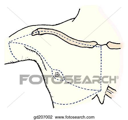 Drawing - Skin incisions.. Fotosearch