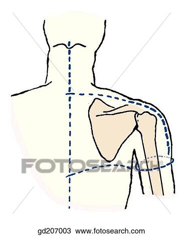 Drawing - Skin incisions.. Fotosearch