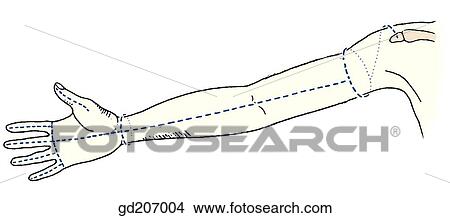 Skin incisions. View Large Illustration Stock Illustration - Skin incisions.. Fotosearch