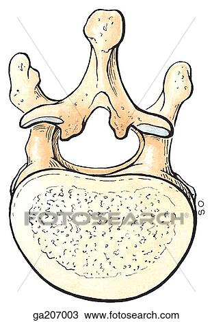 Drawing - Superior view of ossification of the ligamenta flava, showing bony spurs.. Fotosearch