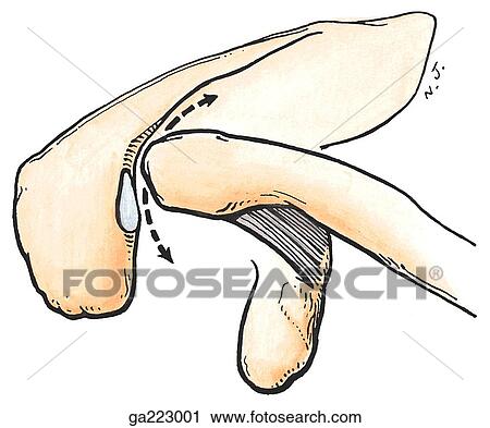 Superior view of the acromioclavicular joint, including the acromion, coracoclavicular ligament, coracoid process, and clavicle. View Large Illustration Clip Art - Superior view of the acromioclavicular joint, including the acromion, coracoclavicular ligament, coracoid process, and clavicle.. Fotosearch
