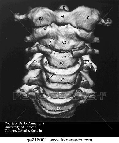 Clip Art - Three-dimensional computer-generated image of the cervical spine, anterior view (D, dens; AT, anterior tubercle of C1; FJ, zygapophyseal joint; TVP, transverse process; UV, uncovertebral joint).. Fotosearch